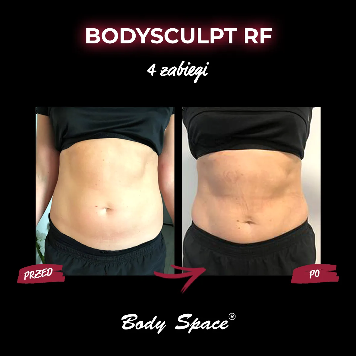Efekty zabiegu BodySculpt RF na brzuchu – przed i po 4 sesjach