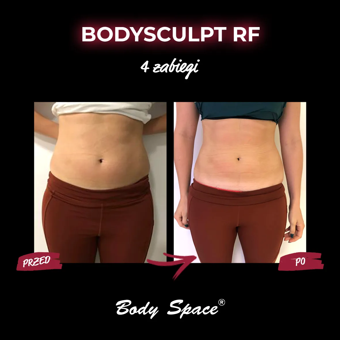 Efekty po 4 zabiegach BodySculpt RF – porównanie brzucha przed i po terapii modelującej